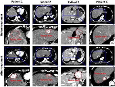 Artificial Intelligent Multi-Modal Point-of-Care System for Predicting Response of Transarterial Chemoembolization in Hepatocellular Carcinoma